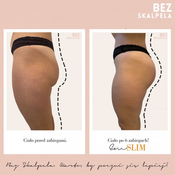 bezskalpela-METAMORFOZA-EM-SLIM