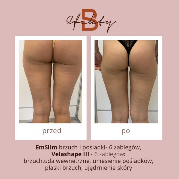 emslim-i-velashape-2optimized