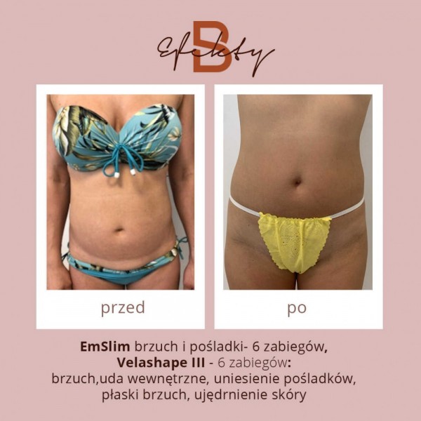 emslim-i-velashape-3optimized