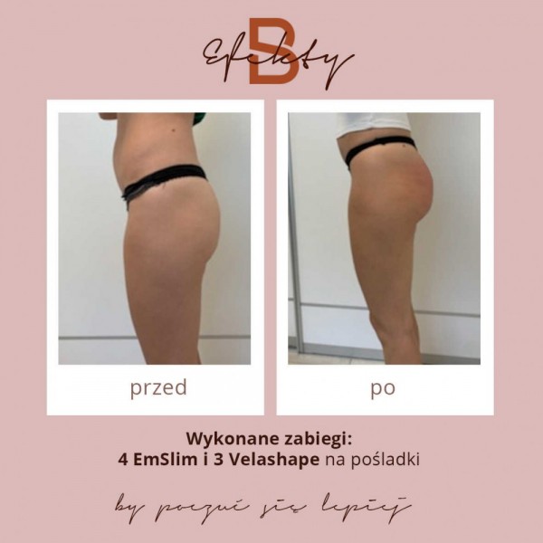 emslim-i-velashape-4optimized
