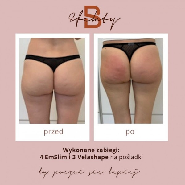 emslim-i-velashape-7optimized