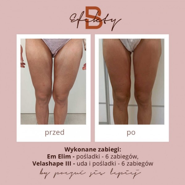 emslim-i-velashape-8optimized