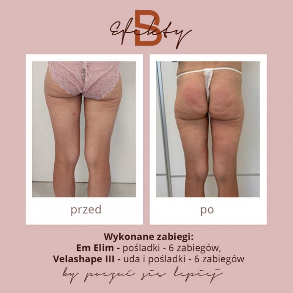emslim-i-velashape-9optimized